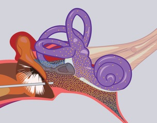 Inner Ear Perfusion With Steroids