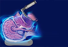 Direct Laryngoscopy