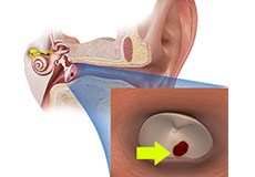 Eardrum Perforation (Tympanic Membrane Perforation)