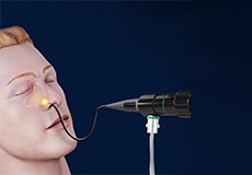 Endoscopic Sinus Surgery