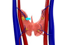 Hyperparathyroidism