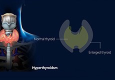 Hyperthyroidism