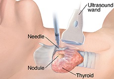 In Office Thyroid or Neck Ultrasound and Biopsies