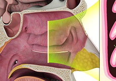 Inferior Turbinate Reduction