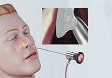 Nasal Polypectomy