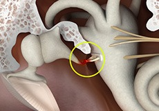 Otosclerosis