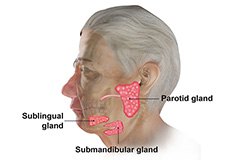 Salivary Gland Surgery