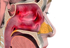 Sinus and Allergy Treatment/Surgery