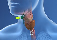 Thyroglossal Duct Cysts