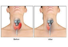 Thyroidectomy