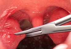 Adult Tonsillectomy