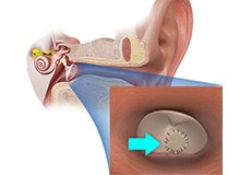 Tympanoplasty